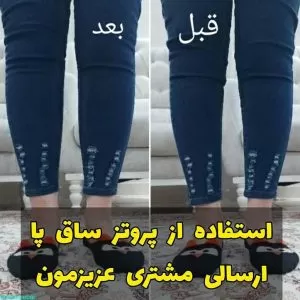 پروتز داخل ساق پا
