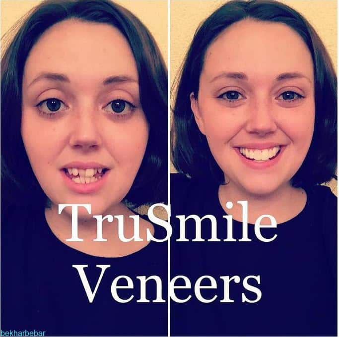 استفاده از لمینت متحرک دندان ترو اسمایل