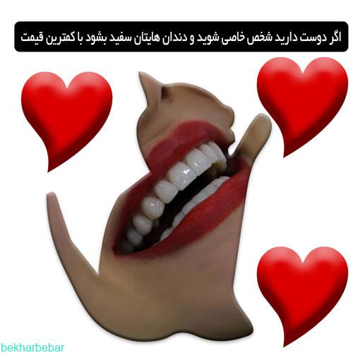 لمینت متحرک دندان