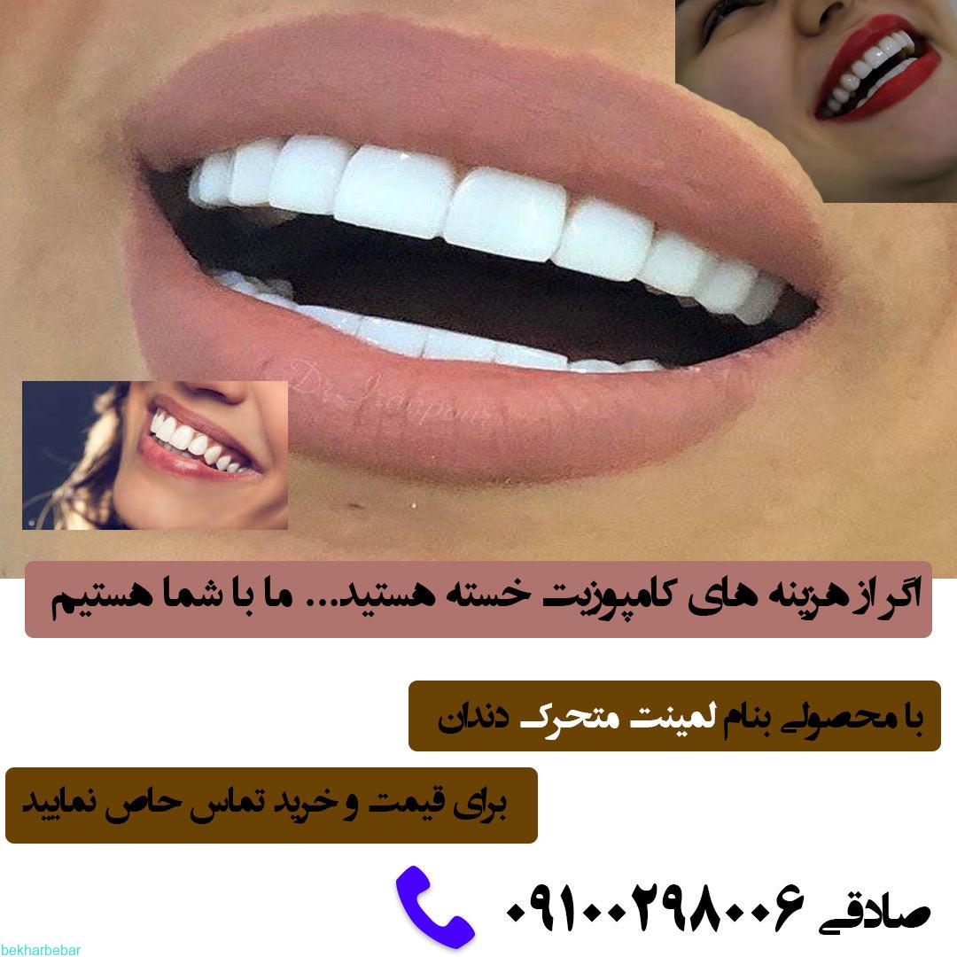 لمینت متحرک دندان