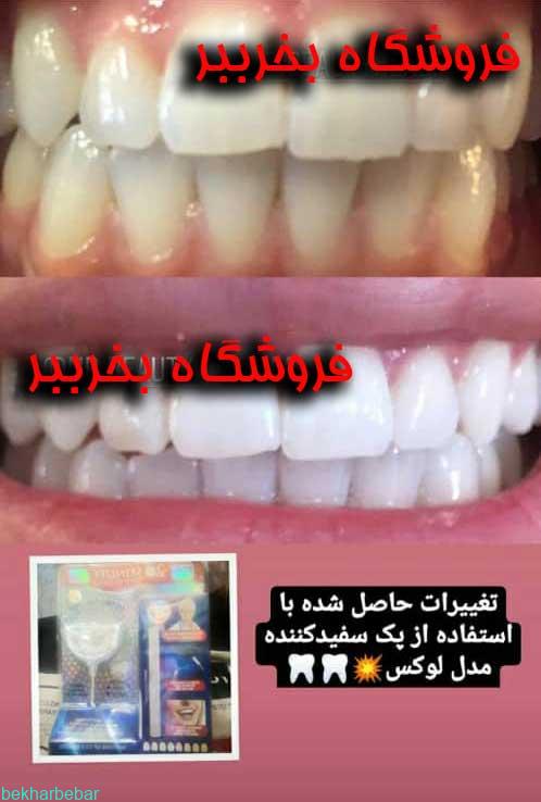 بلیچینگ خانگی دندان لوکس