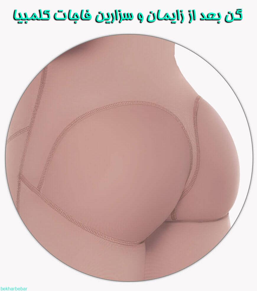 جنس گن سزارین چیست و از چند لایه ساخته شده است؟