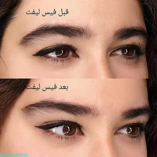 کش لیفت ابرو
