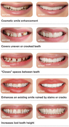 قبل و بعد از استفاده لمینت متحرک دندان