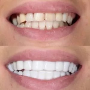 خرید اسنپ آن اسمایل لمینت دندان snap on smile