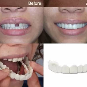 لمینت اسنپ آن اسمایل