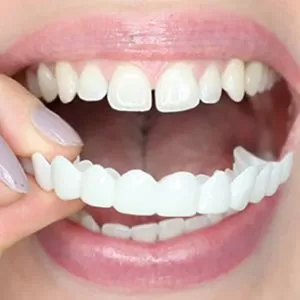 نحوه استفاده از لمینت اسنپ آن اسمایل (snap on smile)