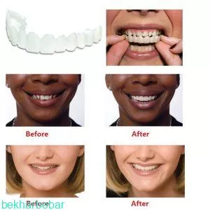 معایب استفاده از لمینت snap on smile