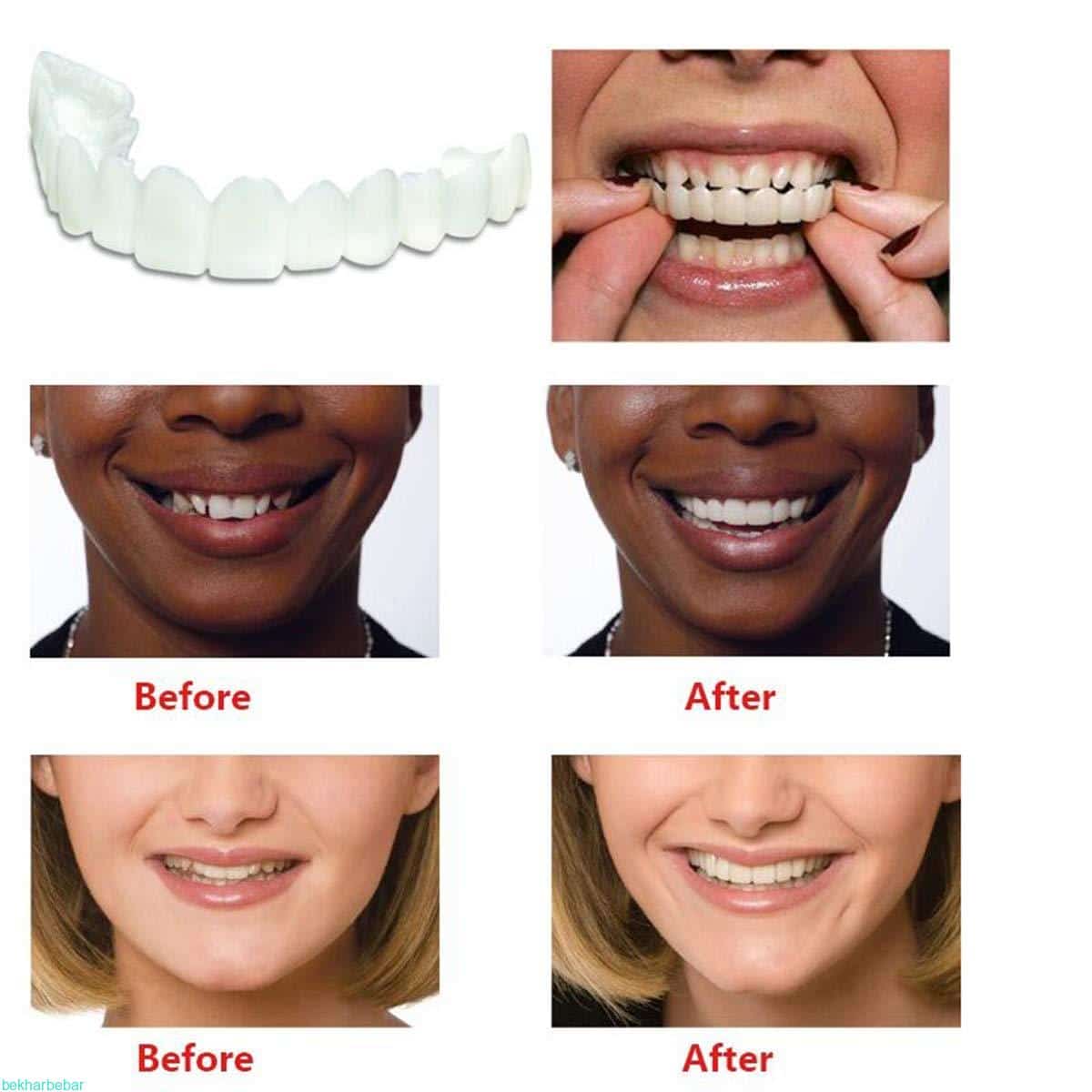 معایب استفاده از لمینت snap on smile