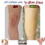 پروتز پوشیدنی ساق پا